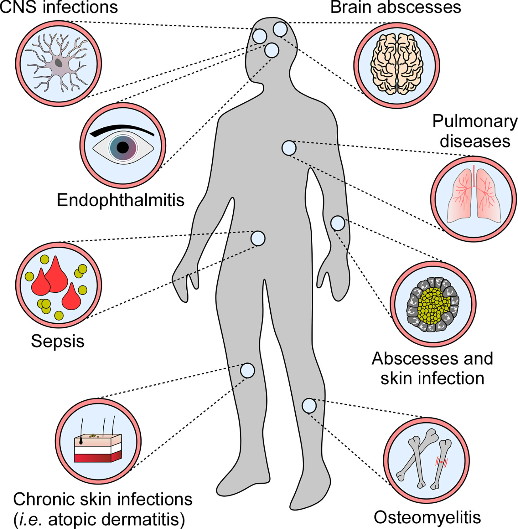 Staphylococcus aureus: A Blemish on Skin Immunity: Cell Host & Microbe