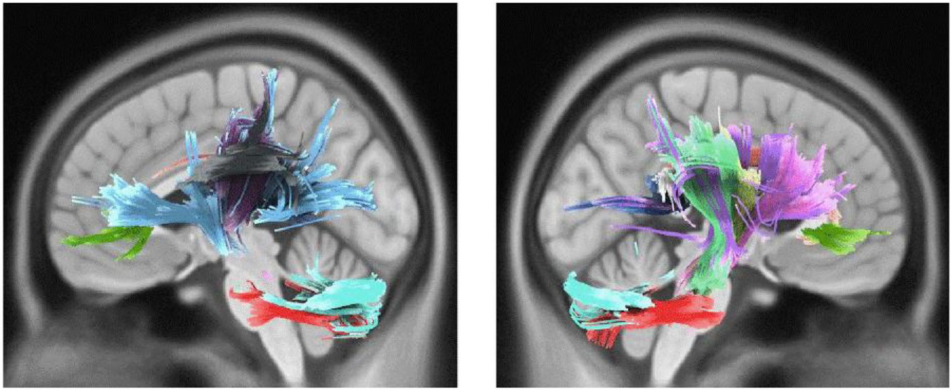 Frontiers Sex Differences are Reflected in Microstructural White Matter Alterations of Musical Sophistication A Diffusion MRI Study