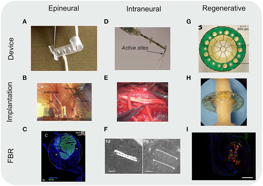 Frontiers  Foreign Body Reaction to Implanted Biomaterials and