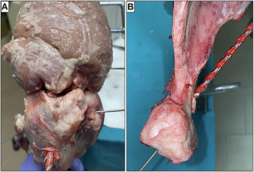 A) Massive rotator cuff tear. (B-E) Intra-articular arthroscopic view