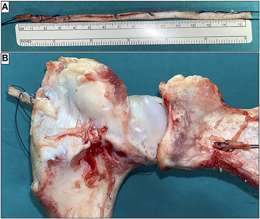 A) Massive rotator cuff tear. (B-E) Intra-articular arthroscopic view