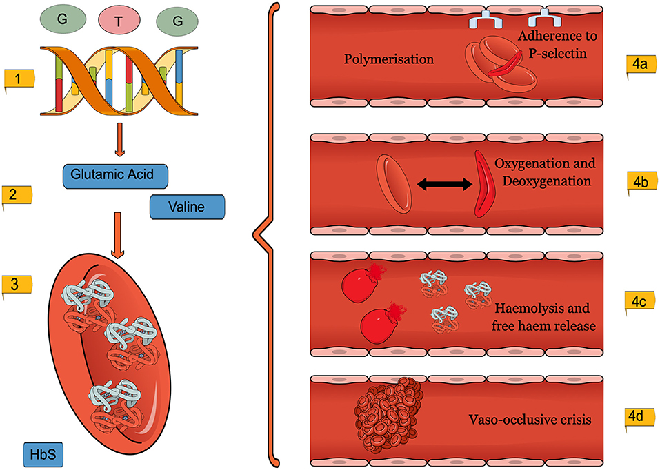 Laboratory Evaluation of Sickle Cell Disease in the ED — Taming