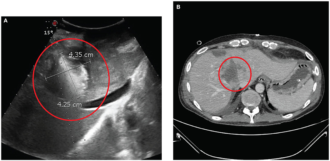 is papillary breast cancer invasive