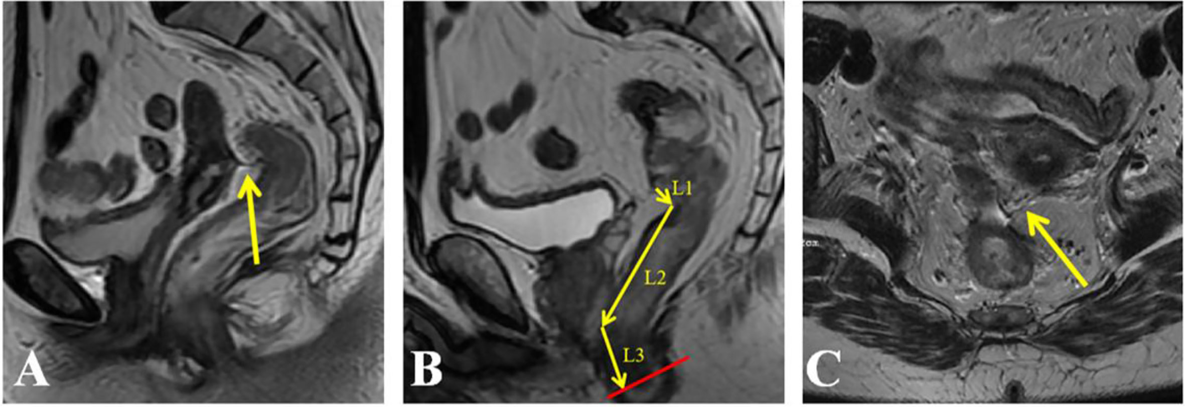 rectal tumor