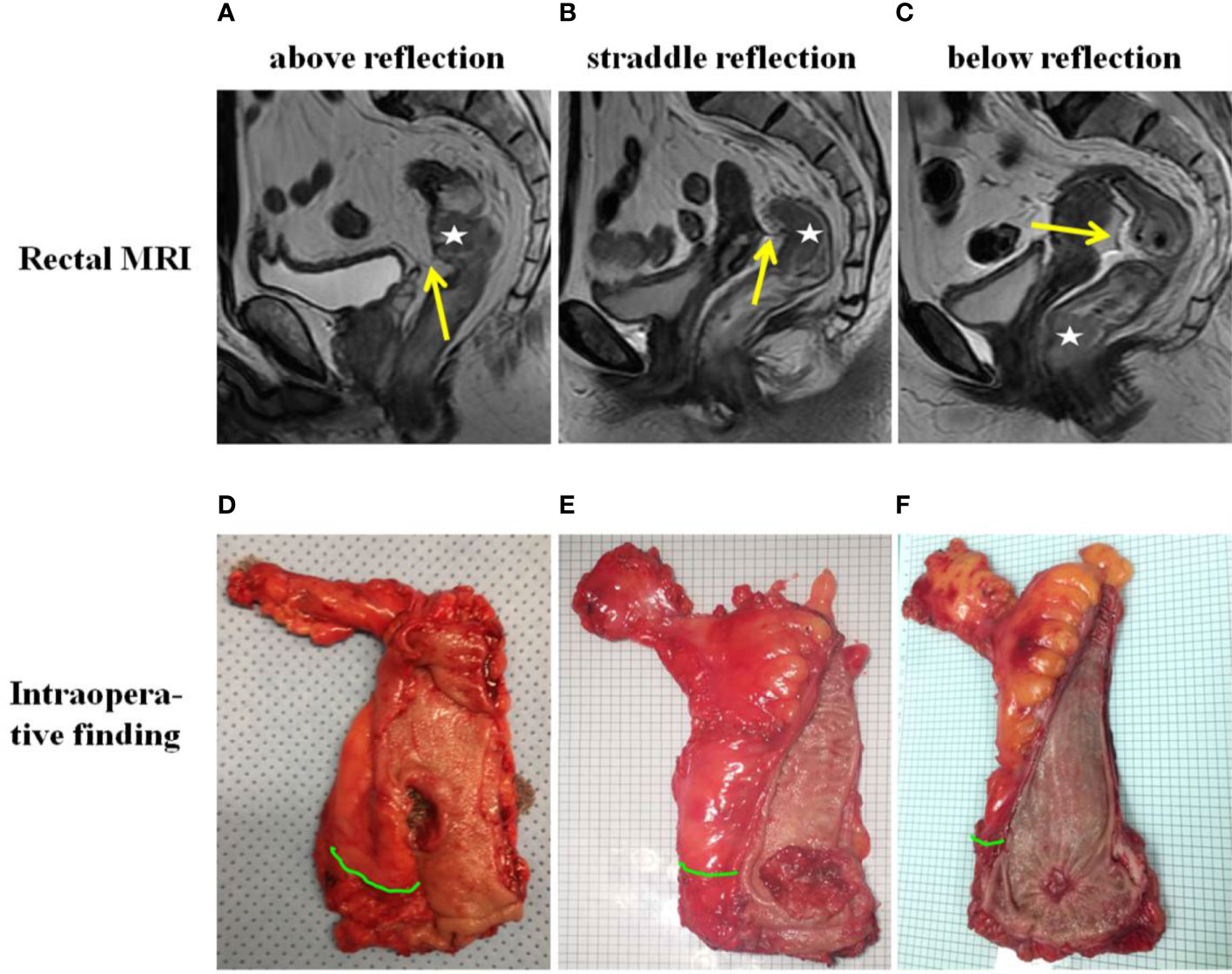 rectal tumor