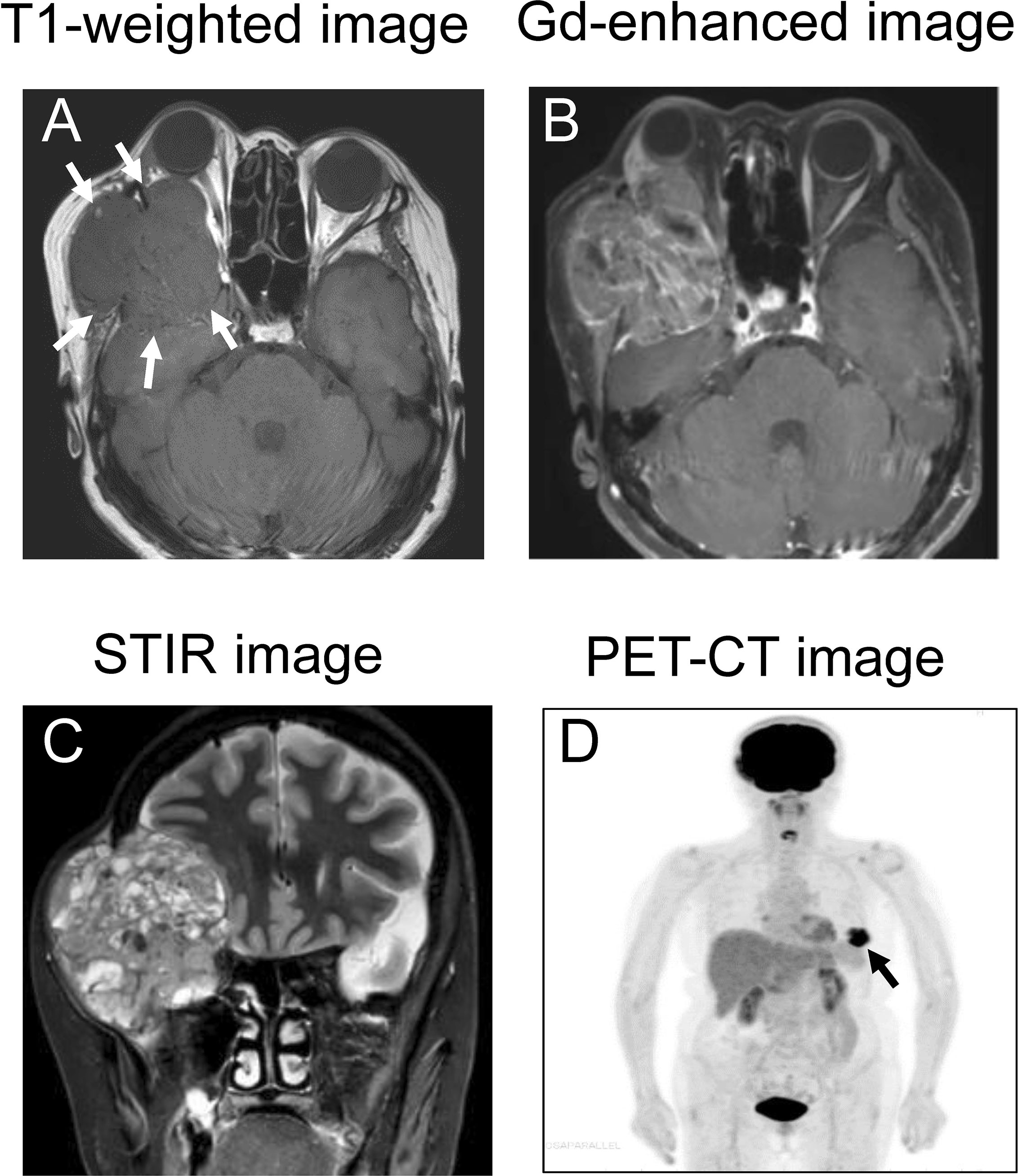 Cancer de prostata articulo - Cancer de prostata metastase ossea