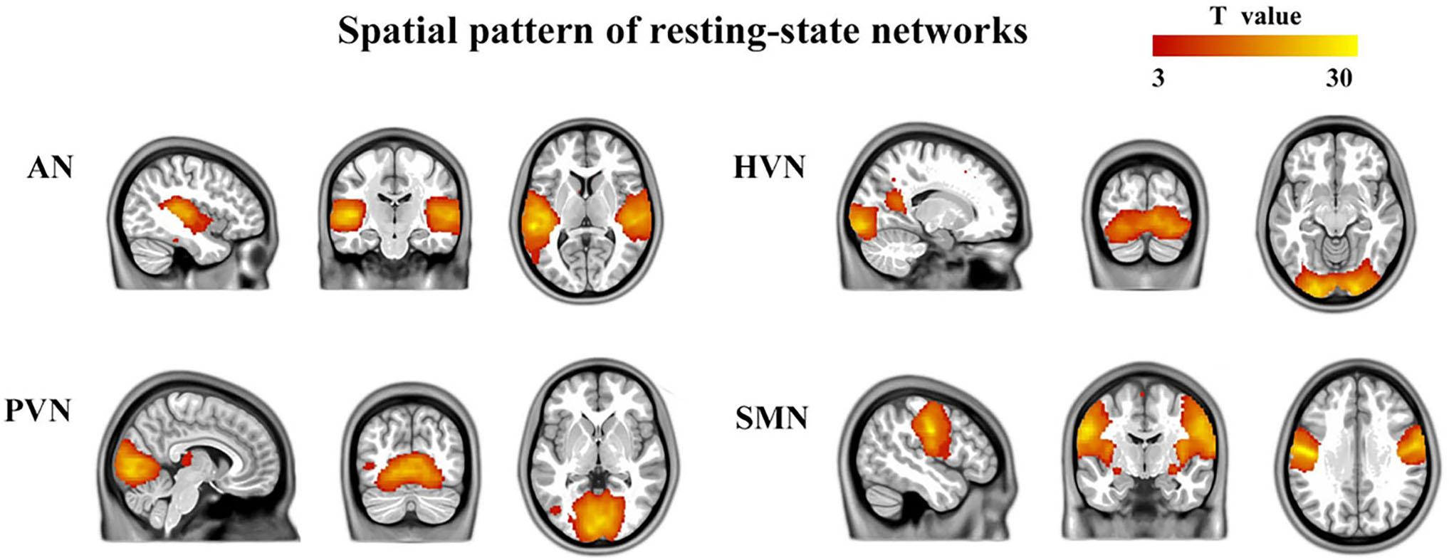 Frontiers Atypical Resting State Functional Connectivity Of Intra Inter Sensory Networks Is Related To Symptom Severity In Young Boys With Autism Spectrum Disorder Physiology