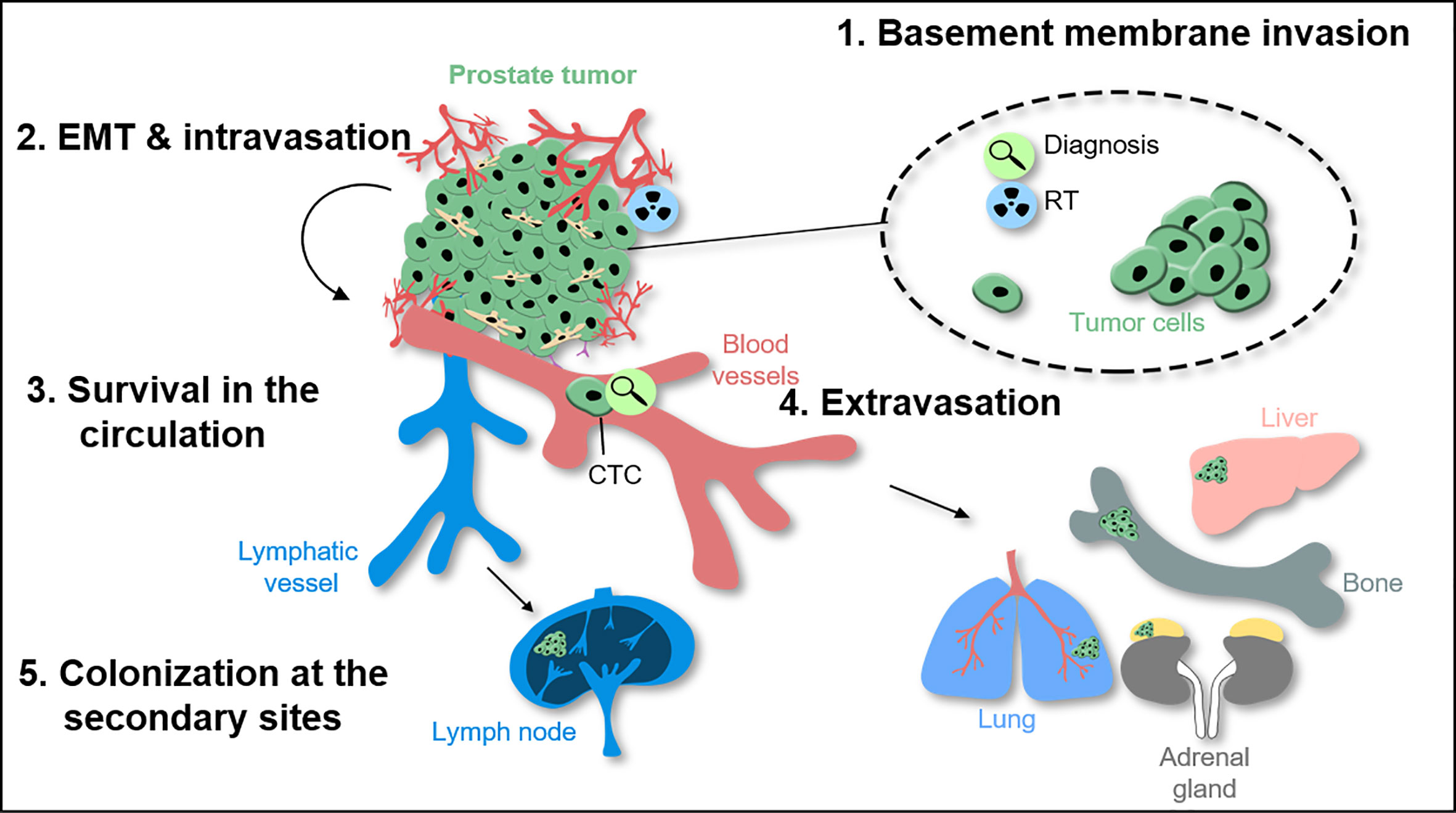 prostate cancer with metastasis to spine)