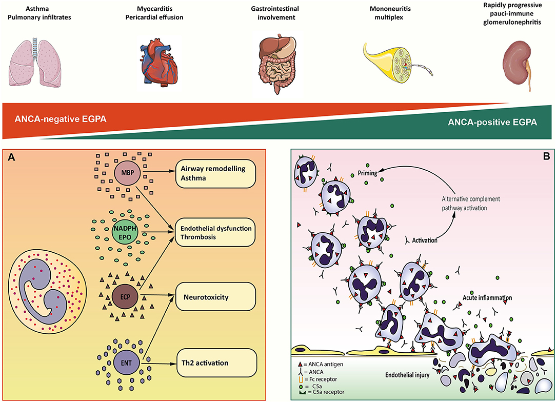 Frontiers Eosinophilic Granulomatosis With Polyangiitis Dissecting