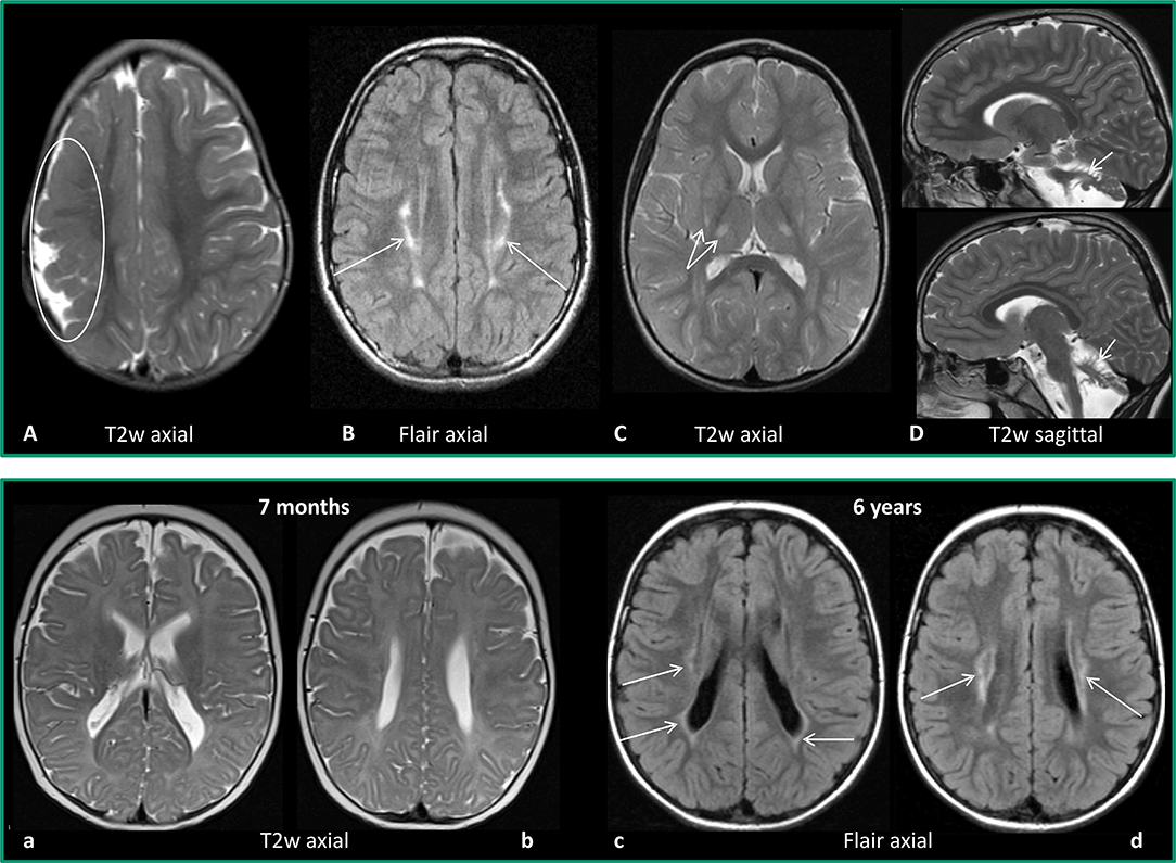 Cerebral Palsy Brain Scan Comparison