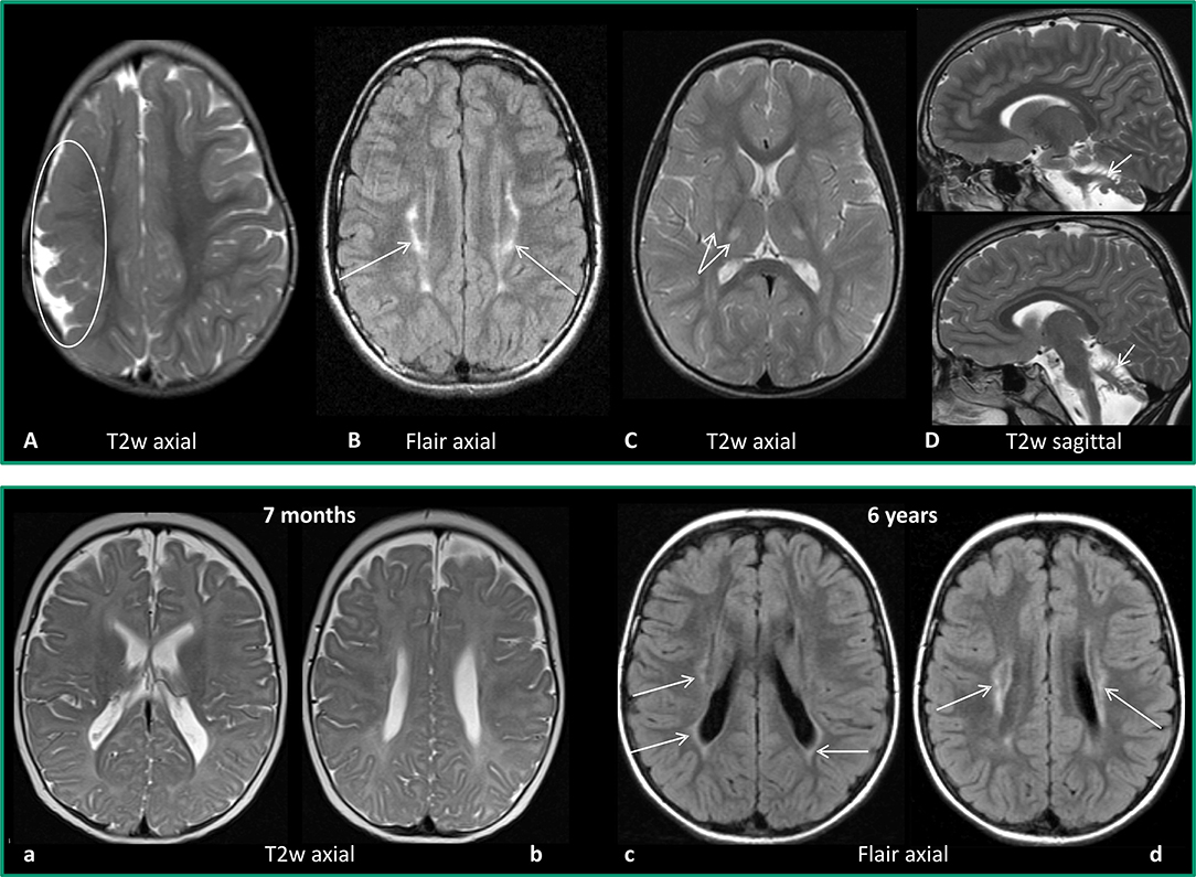 normal brain mri