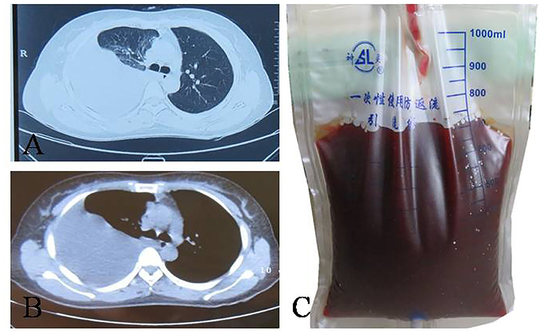 A case report of thoracic endometriosis – A rare cause of