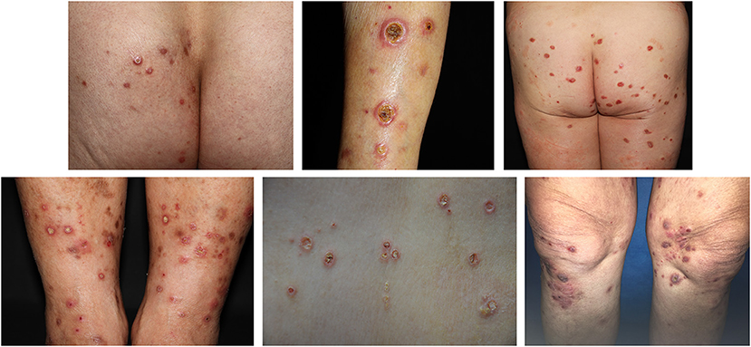 en progreso a nombre de abrazo Frontiers | Dermoscopy Features of Acquired Perforating Dermatosis Among 39  Patients