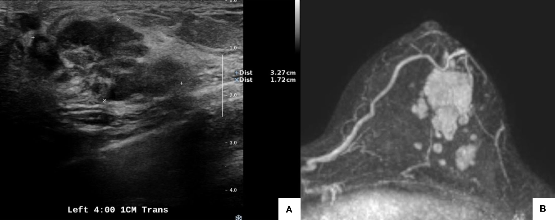 Assessment of low-cost surgical metallic clip placement for tumor  localization in BIRDAS VI breast cancer patients undergoing neoadjuvant  chemotherapy, Egyptian Journal of Radiology and Nuclear Medicine
