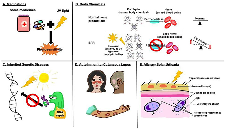Figure 1 - Causes of photosensitivity in kids.