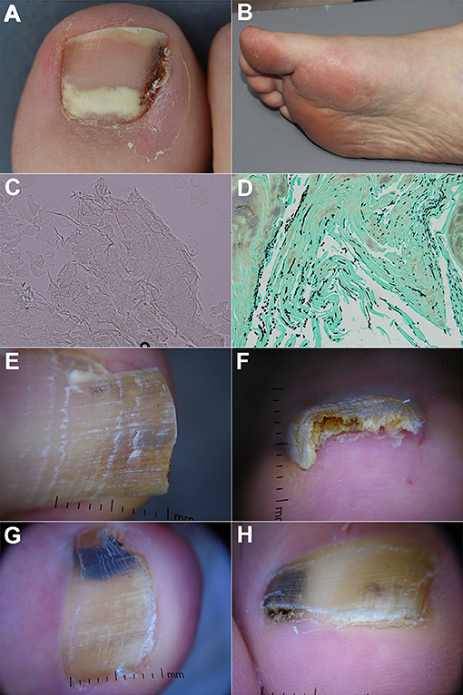 Frontiers Diagnosis Of Onychomycosis From Conventional Techniques And Dermoscopy To Artificial Intelligence Medicine