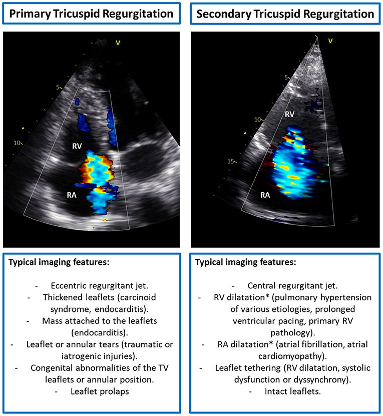 Frontiers Multi Modality Imaging For Interventions In Tricuspid Valve