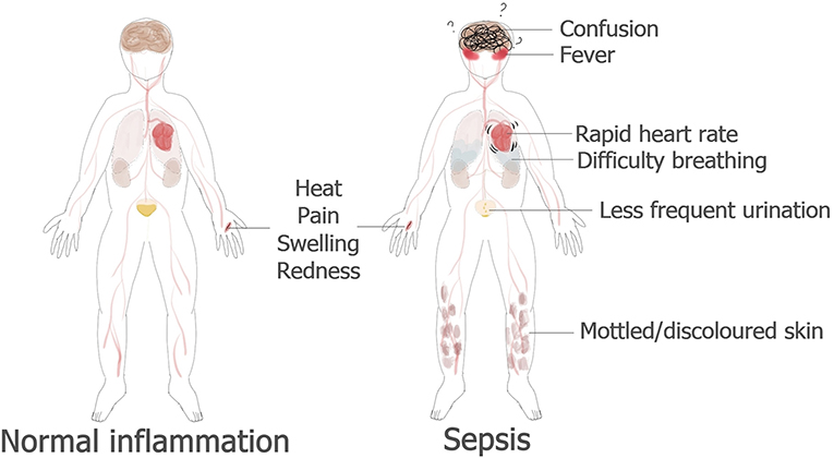 Figure 1 - Normal inflammation compared to sepsis.