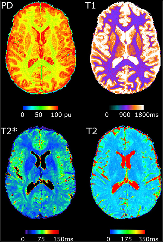 Frontiers  Multiparametric magnetic resonance imaging-derived