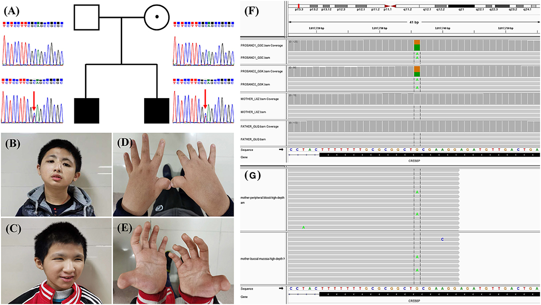 A novel CREBBP mutation and its phenotype in a case of Rubinstein