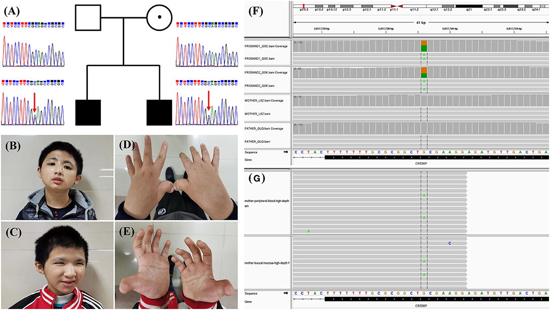 Mosaic CREBBP mutation causes overlapping clinical features of