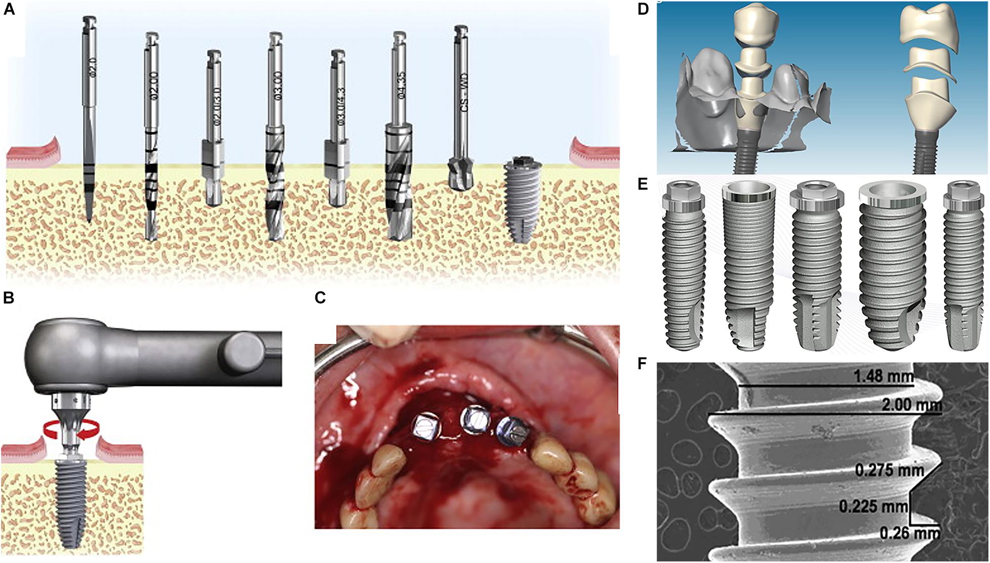 Frontiers | A Brief Review on the Evolution of Metallic Dental Implants:  History, Design, and Application