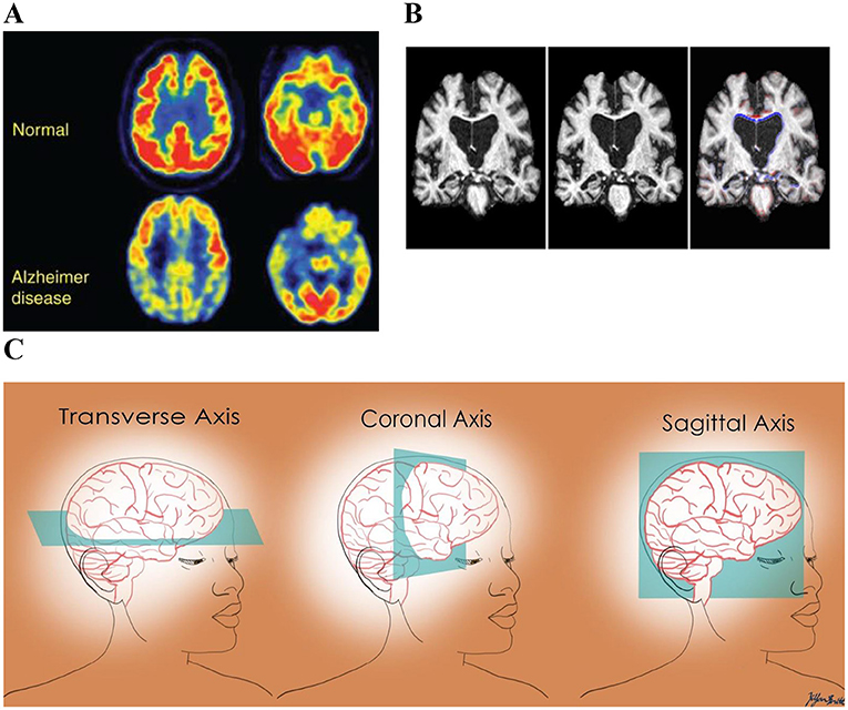 Figure 2 - (A) A PET tracer is used to show the high metabolic activity (red) that is typical for a normal brain.