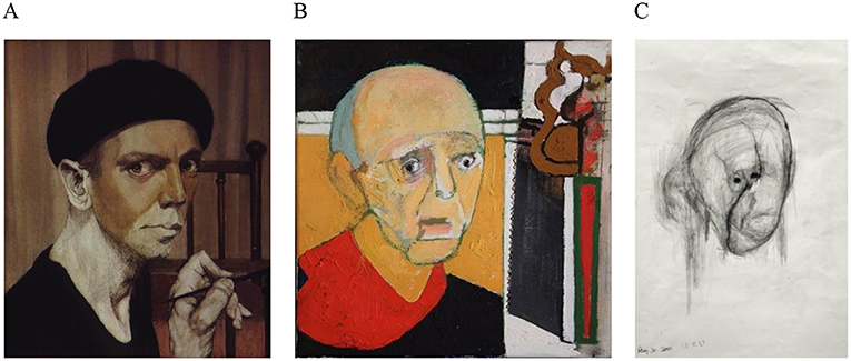 Figure 3 - Progression of Alzheimer’s through the eyes of an actual patient.