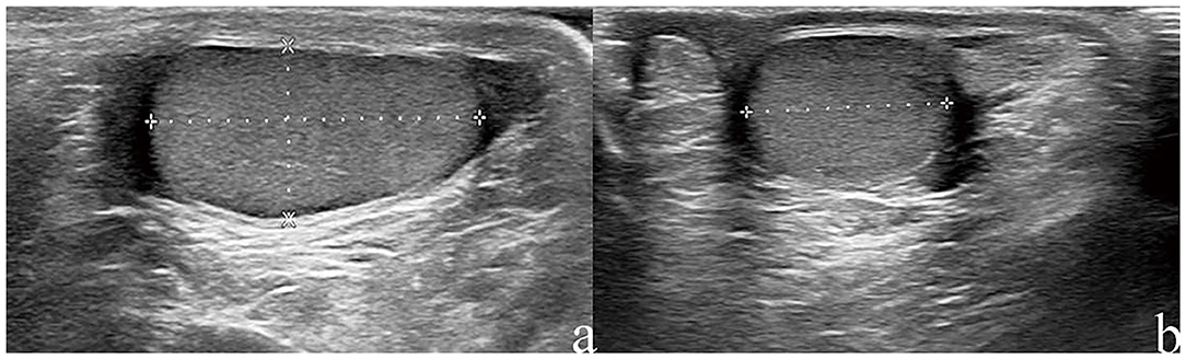 Frontiers Referential Values Of Testicular Volume Measured By 