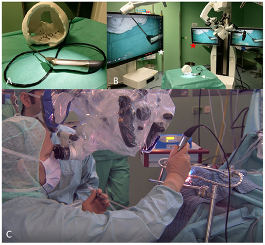 Frontiers | Endoscopic Assistance in the Deep and Narrow Spaces of the Brain—Microscopic  Tumor Surgery Supported by the New Micro-Inspection Tool QEVO® (Technical  Note)