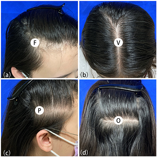 Frontal Fibrosing Alopecia A Womans Receding Hairline