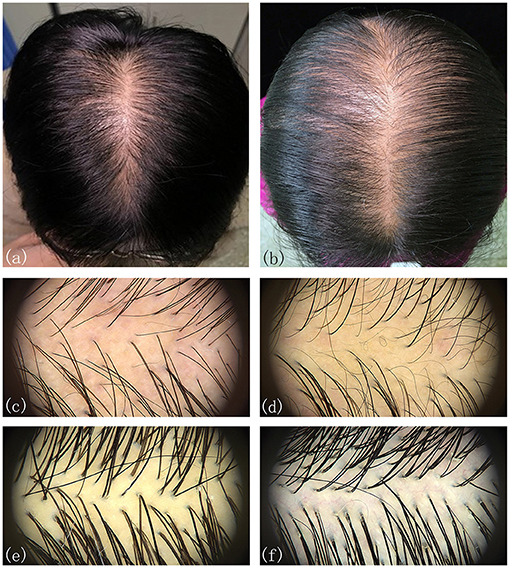 Female Hair Loss TreatmentFemale Pattern Hair Loss FPHL or Female Pattern  Baldness FPB is often by Australian Hair  Scalp Clinic  Issuu