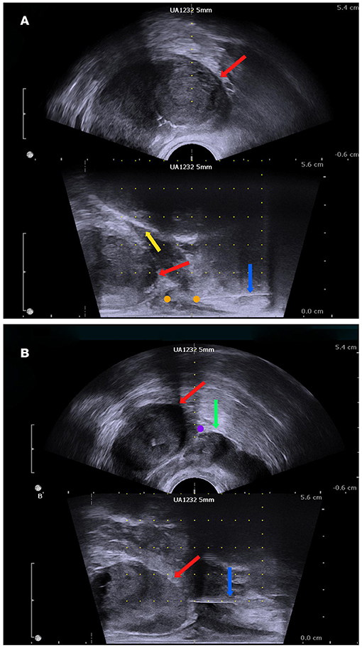 Perineal nerve block versus periprostatic block for patients undergoing  transperineal prostate biopsy (APROPOS): a prospective, multicentre,  randomised controlled study - eClinicalMedicine