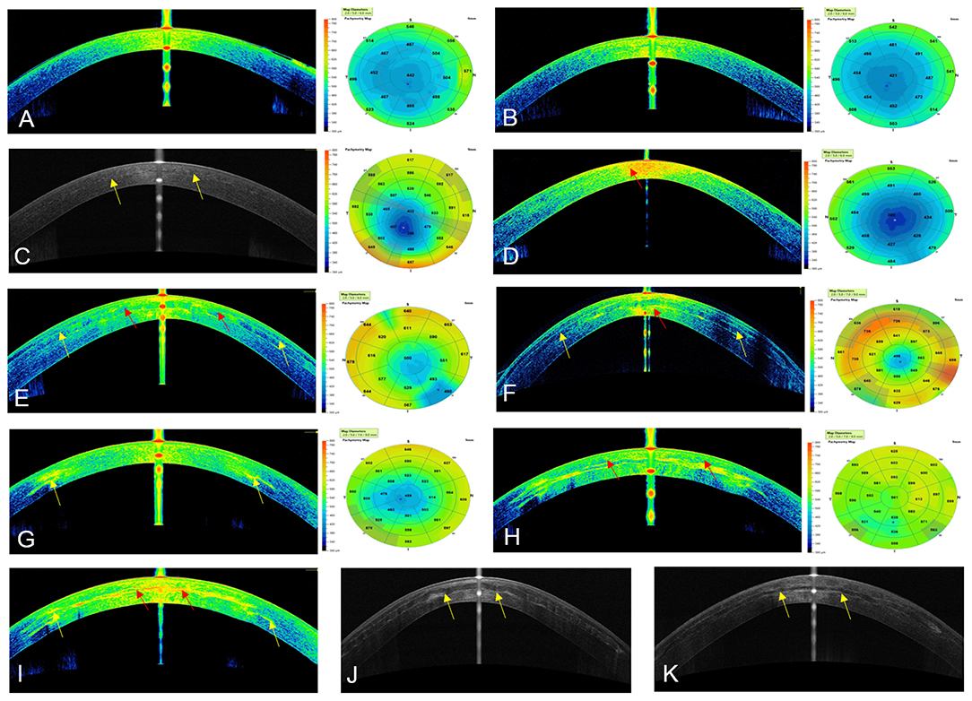 In vivo corneal elastography: A topical review of challenges and  opportunities - Computational and Structural Biotechnology Journal