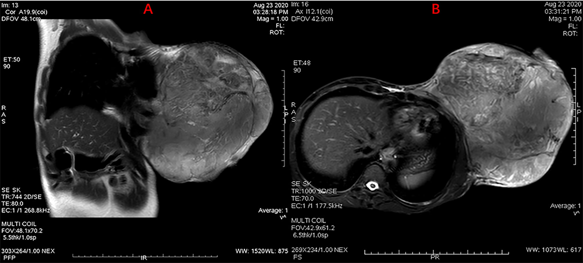 Frontiers | A Giant Borderline Phyllodes Tumor of Breast With Skin ...