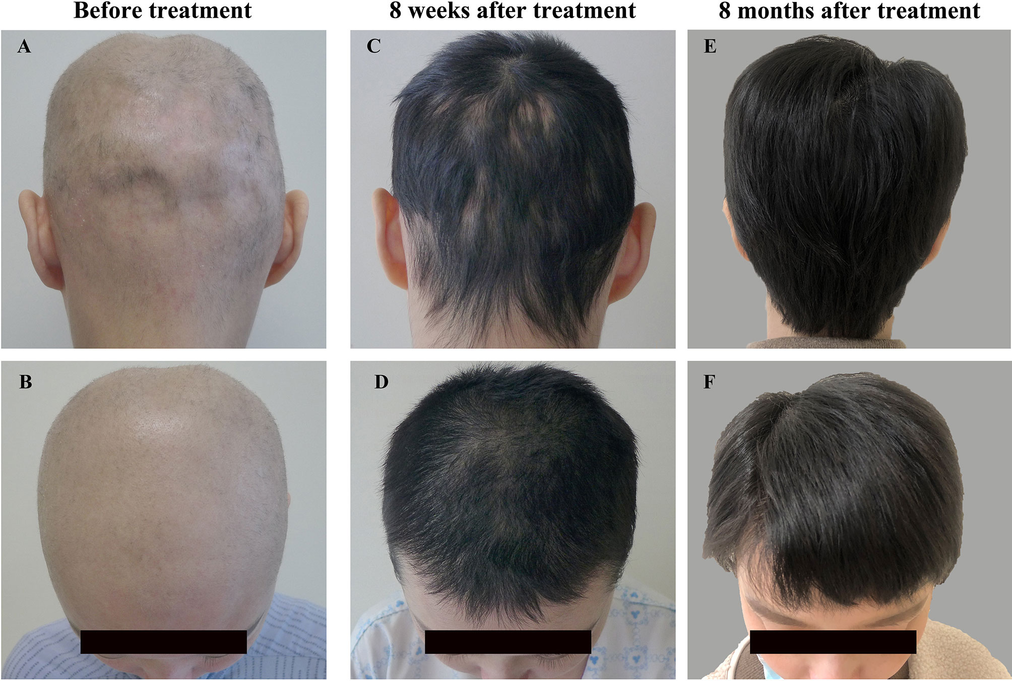 Frontiers | Case Report: Reversal of Long-Standing Refractory Diffuse  Non-Scarring Alopecia Due to Systemic Lupus Erythematosus Following  Treatment With Tofacitinib