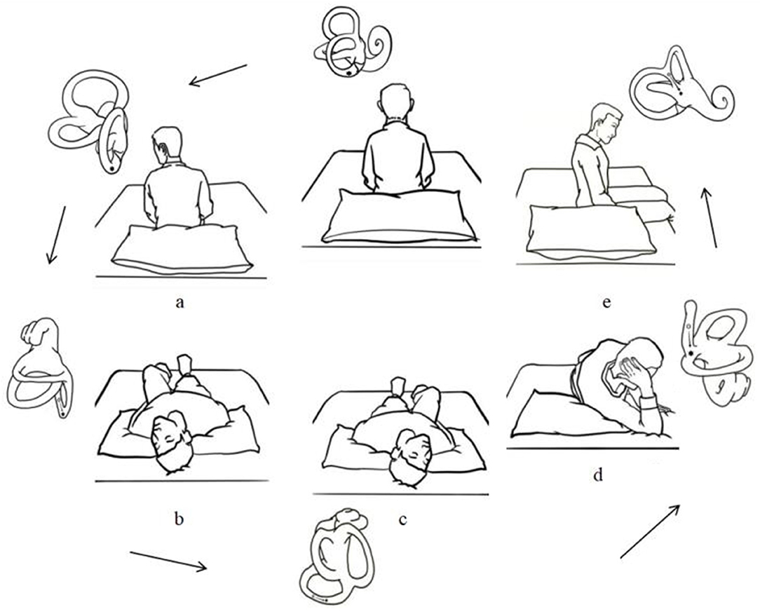 hallpike maneuver illustration