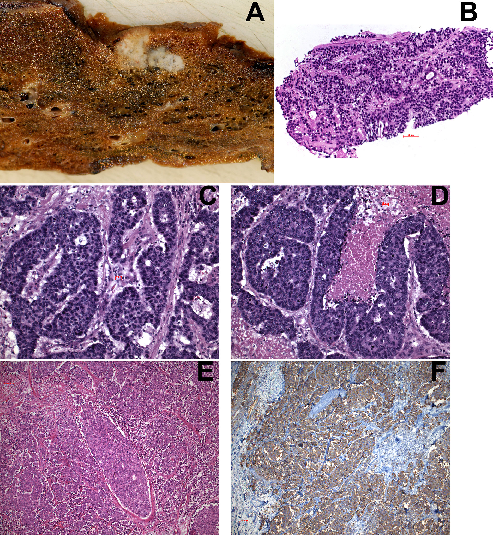 Frontiers Diagnosis And Molecular Profiles Of Large Cell