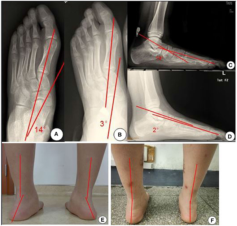 On the cure of club-foot without cutting tendons : and on certain