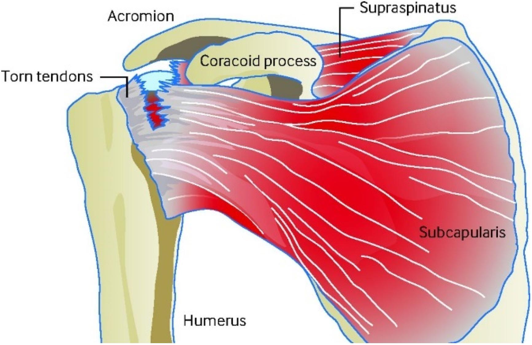 Stem Cell Treatment for Torn Rotator Cuff : Our New Research