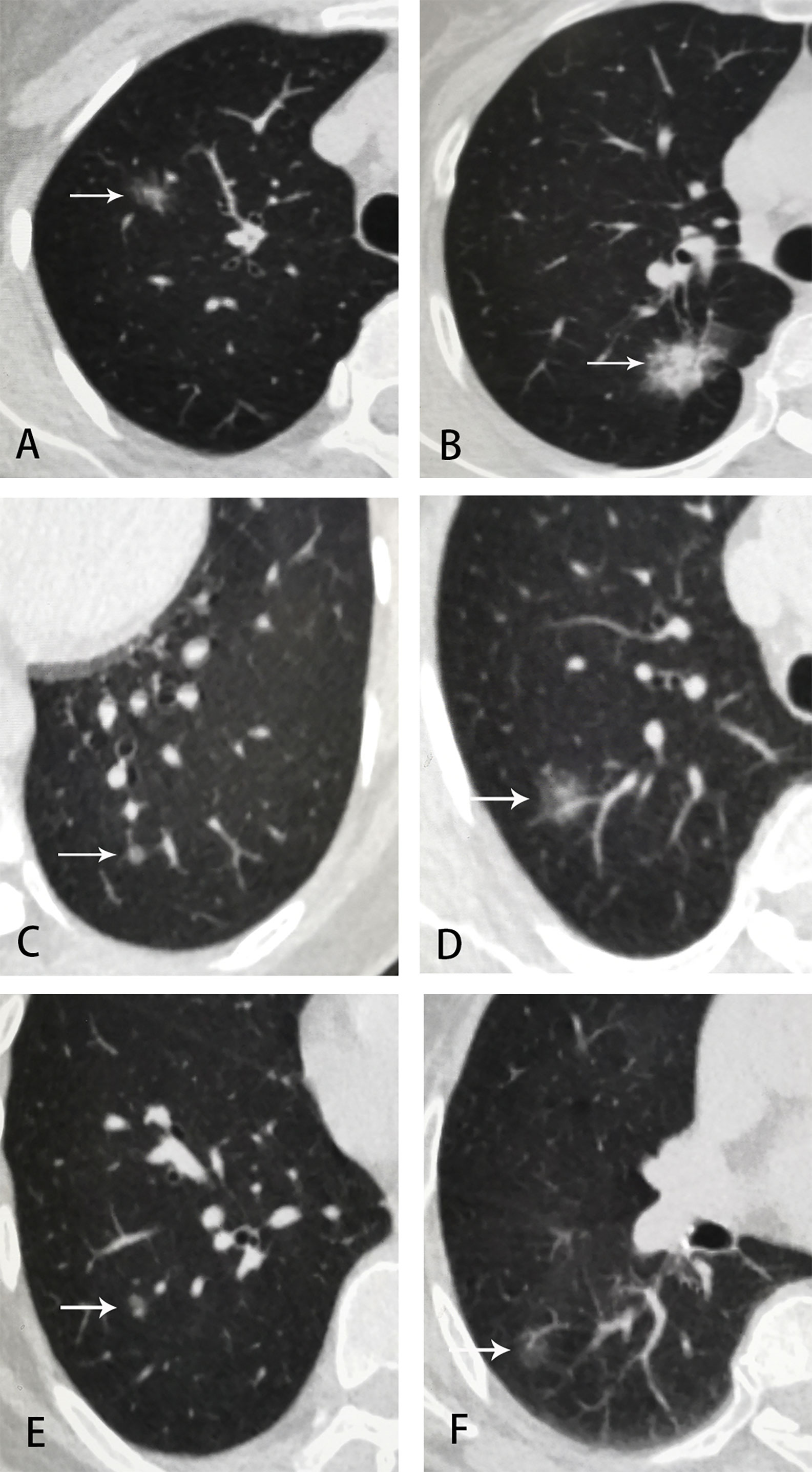 liver metastatic mesothelioma