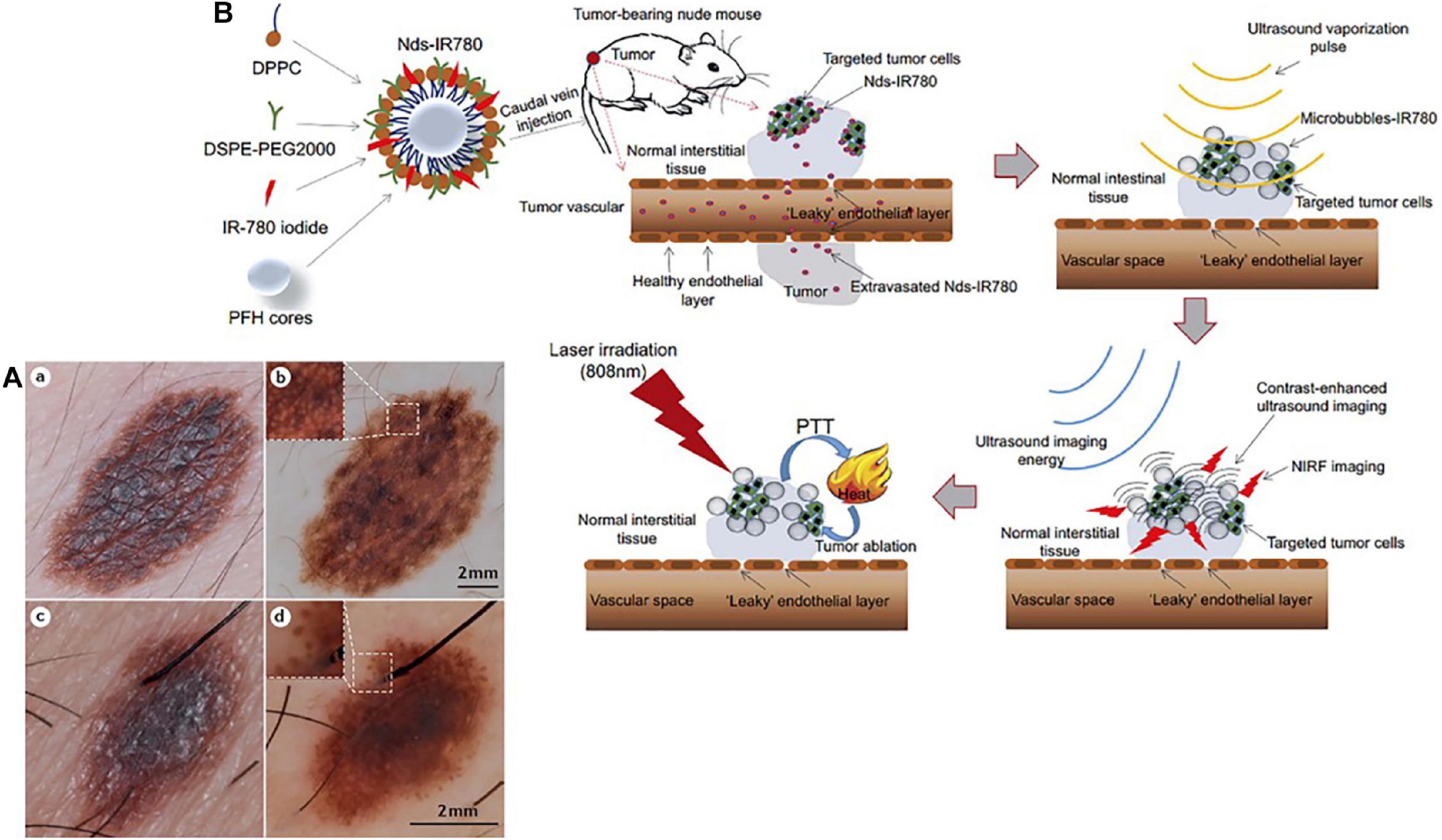 Nanodelivery systems for cutaneous melanoma treatment - ScienceDirect