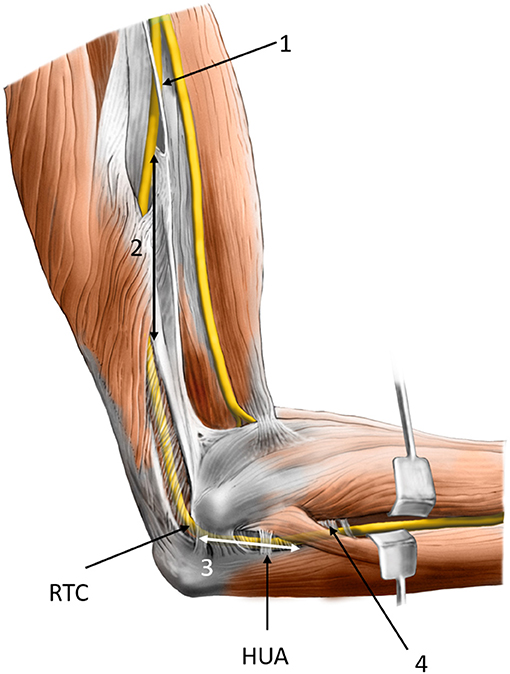 Ulnar Nerve Decompression at the Elbow Westmead, NSW