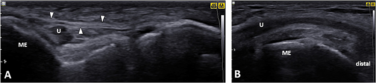 Frontiers  Ulnar Neuropathy at the Elbow: From Ultrasound Scanning to  Treatment