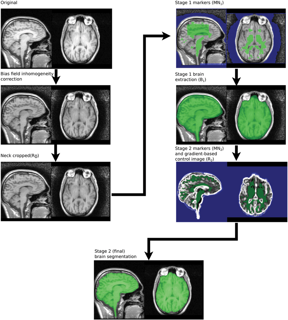 Brain zones. Bias field.