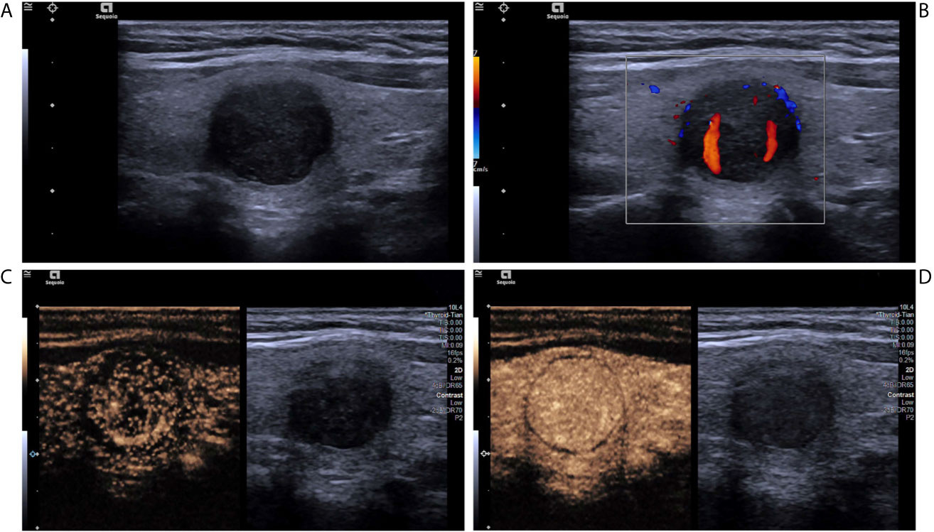 Frontiers  Contrast-Enhanced Ultrasound in the Differential Diagnosis and  Risk Stratification of ACR TI-RADS Category 4 and 5 Thyroid Nodules With  Non-Hypovascular