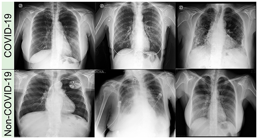 chest x ray pneumonia