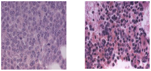 Figure 6 - Bone marrow from a multiple myeloma patient before and after Velcade®.