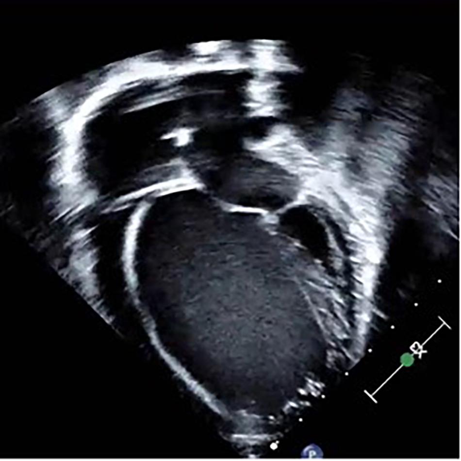 Basic Echocardiography in Dilated Cardiomyopathy