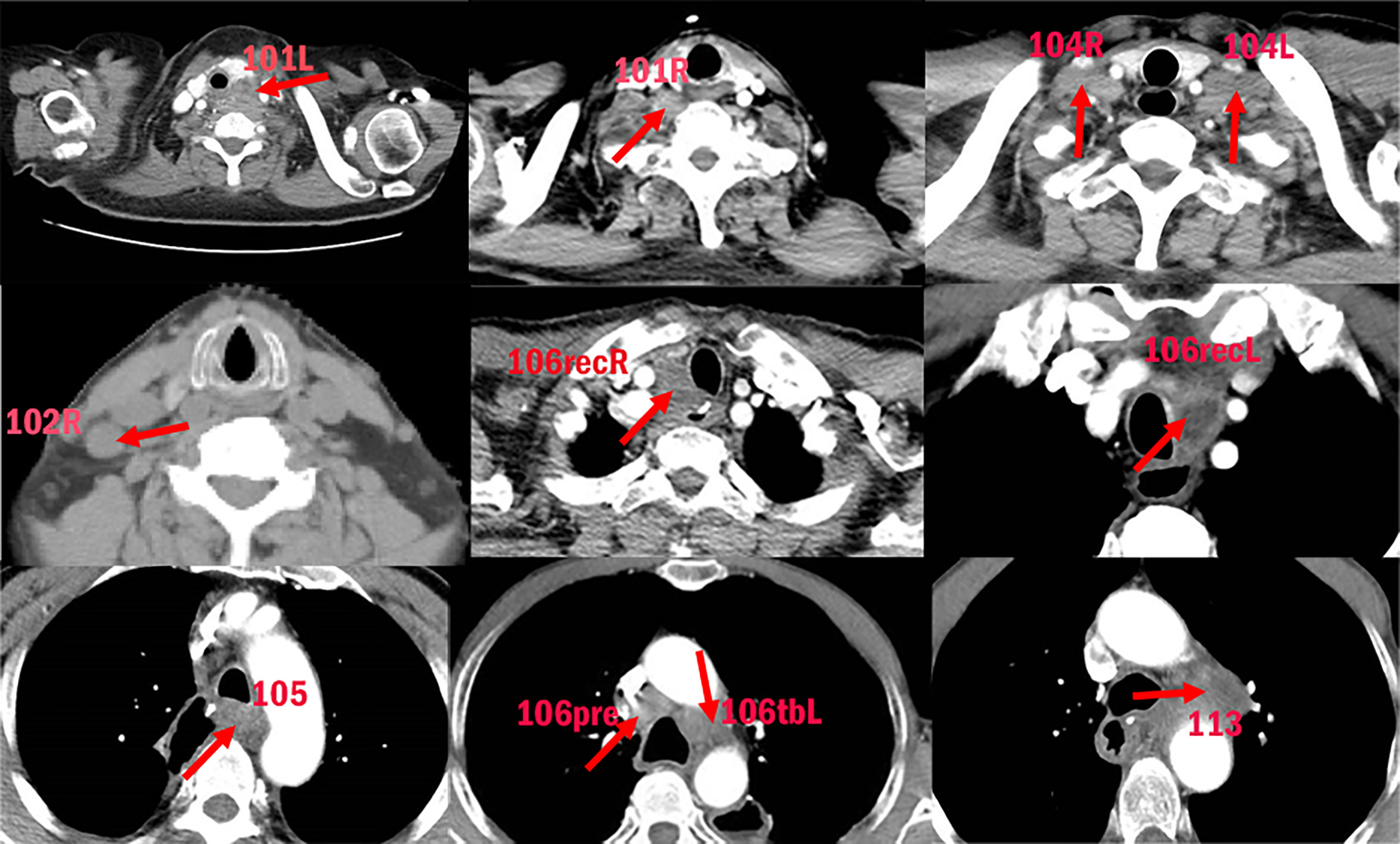 Frontiers Mapping Of Cervical And Upper Mediastinal Lymph Node